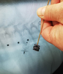 Tobi, the surgeon carefully blocked the hole in the heart with a tiny hand knitted device know as an  ‘occluder’